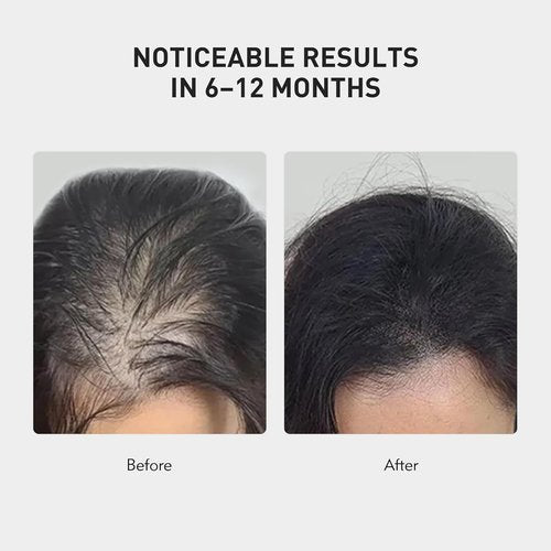 KINTOR Hair Regrowth Spray - 0.9% KX-826 Formula for Healthy Hair Growth | Oil Control, 60ml