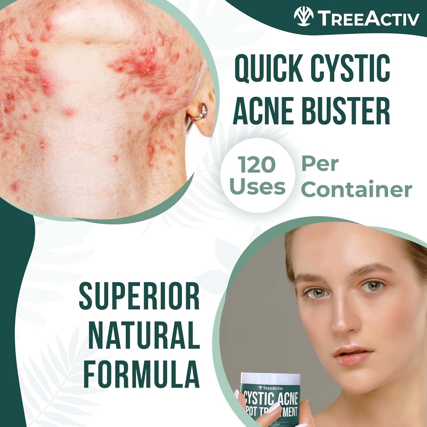 TreeActiv Cystic Acne Spot Treatment Paste - Sulfur & Tea Tree Oil for Deep Breakouts | 0.5 oz