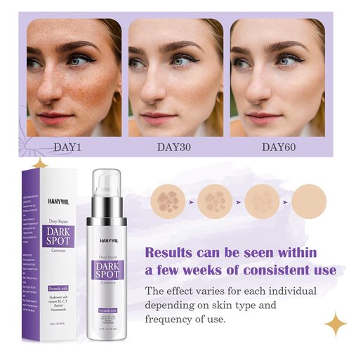 HANYWIL Dark Spot Remover Serum - Retinol & Niacinamide Formula for Melasma, Sun & Age Spots | 1.7 Fl Oz