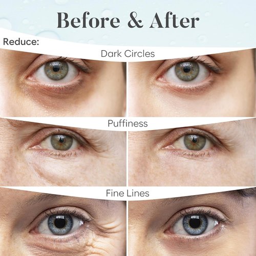 AURAE Hyaluronic Acid Under Eye Patches - Hydrating Eye Mask for Dark Circles & Puffiness | 30 Pairs