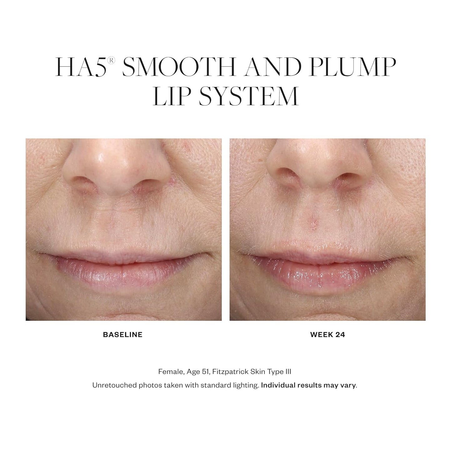 SkinMedica HA5 Lip Plumper System - Hydrating & Volumizing Formula for Fuller, Smoother Lips | 0.05 Oz