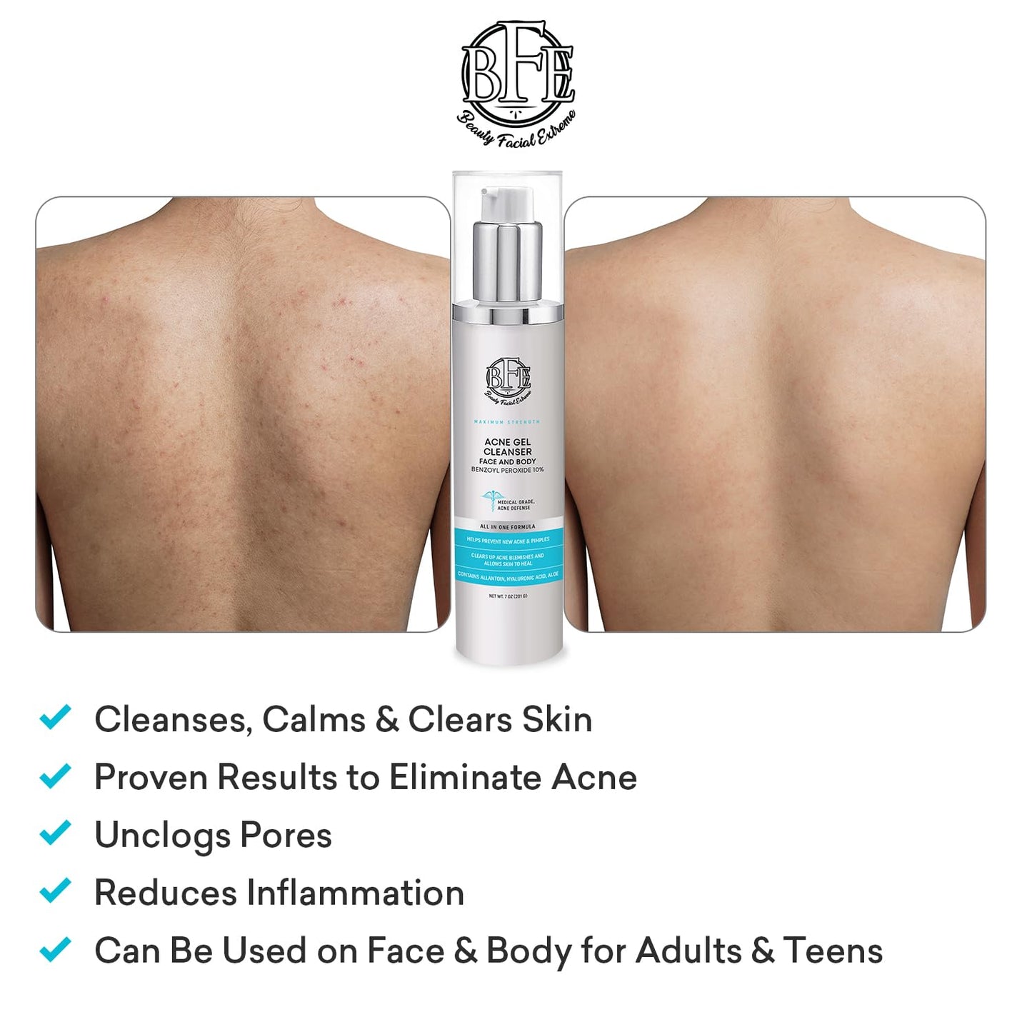 Acne Face wash Treatment with Benzoyl Peroxide 10% - Fight Acne Blemishes on Contact for Cystic Breakouts, Oily Skin, Clogged Pores, Blackhead, Whitehead & Pimples. Achieve Clear Skin.