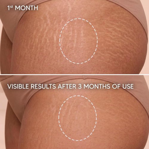 Cicatrissim Stretch Mark Cream - Softens & Firms Skin, Evens Tone - All Skin Types - 150g