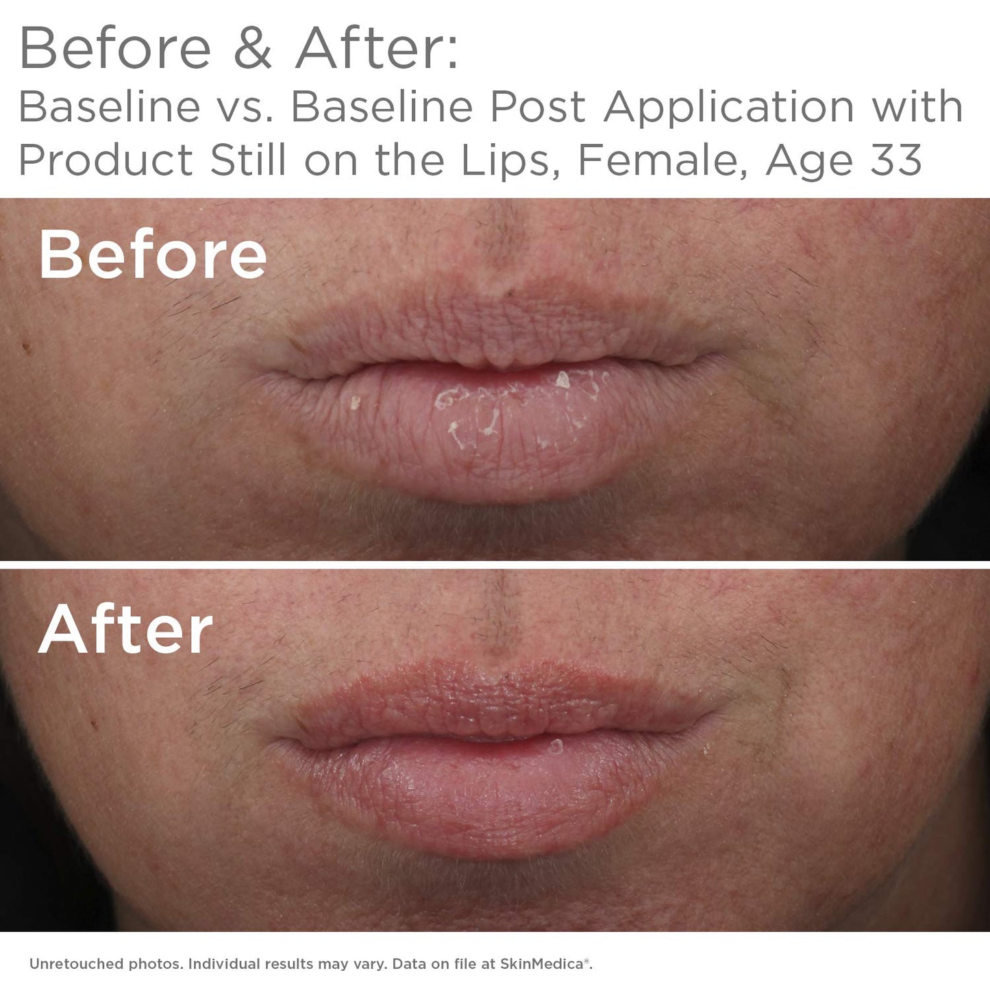 SkinMedica HA5 Lip Plumper System - Hydrating & Volumizing Formula for Fuller, Smoother Lips | 0.05 Oz