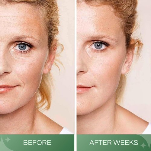 Hyaluronic Acid Serum by Skiennix - 100% Pure Anti-Aging Formula | 5oz Moisturizing & Brightening for All Skin Types