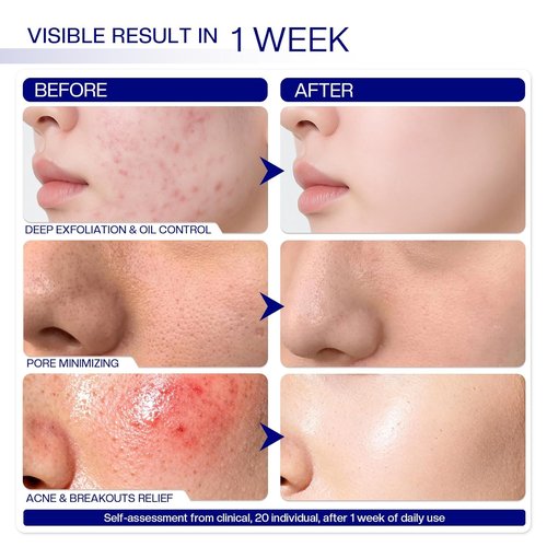 Morovan Glycolic Acid Pads - 30% Dual-Sided Exfoliator for Blemishes & Skin Clarity | 65 Pads
