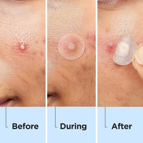 Glowpatch Pimple Patches for Face, Invisible Acne Patches 330 Count, Daytime Ultra Thin Spot Stickers for Covering Blemishes, Original Hydrocolloid Zit Patch 4 Sizes for Overnight Care (Day + Night)