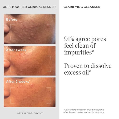 Murad Acne Control Clarifying Cleanser - Salicylic Acid & Green Tea for Deep Pore Cleansing | 6.0 oz