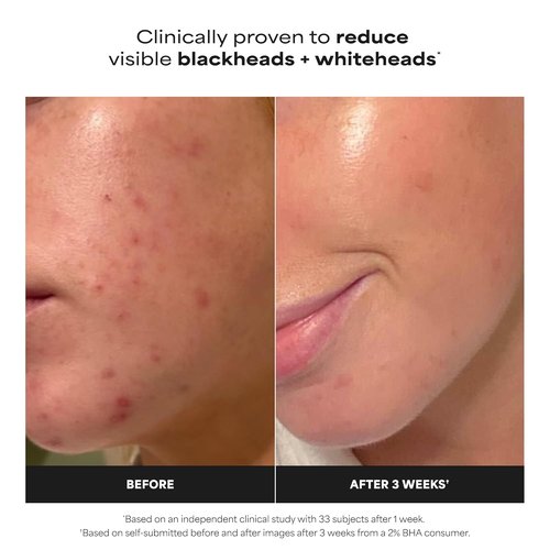 Paula's Choice SKIN PERFECTING 2% BHA Liquid Exfoliant - Salicylic Acid Facial Polish for Enlarged Pores & Fine Lines - Fragrance-Free