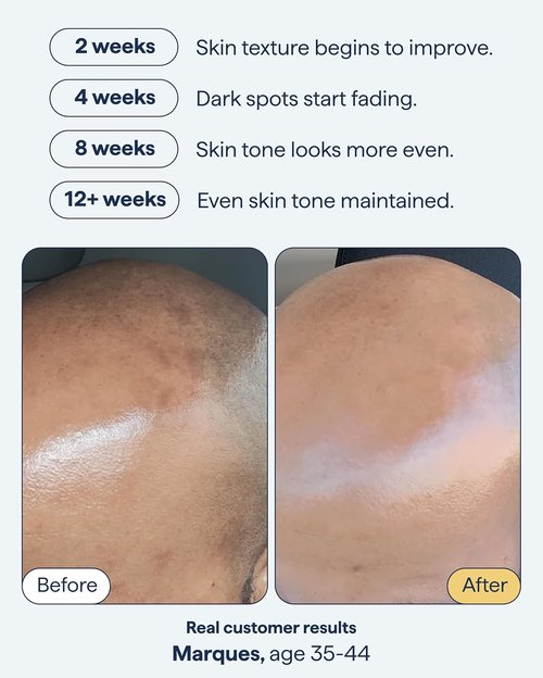 Dr. Shah Remedy for Dark Spots - Advanced Night Treatment with Retinol & Kojic Acid | 1 fl. oz for Discoloration & Uneven Tones