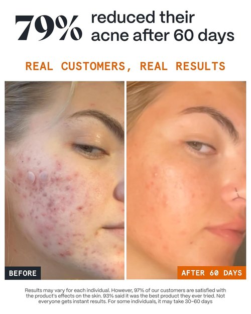 Norse Organics | Complete Pimple Control System 2.0 | 4-Step Skincare Kit with Arctic Herbs | Includes Day & Night Balms, Scar Balm, Face Scrub | All Skin Types (4 Pcs)