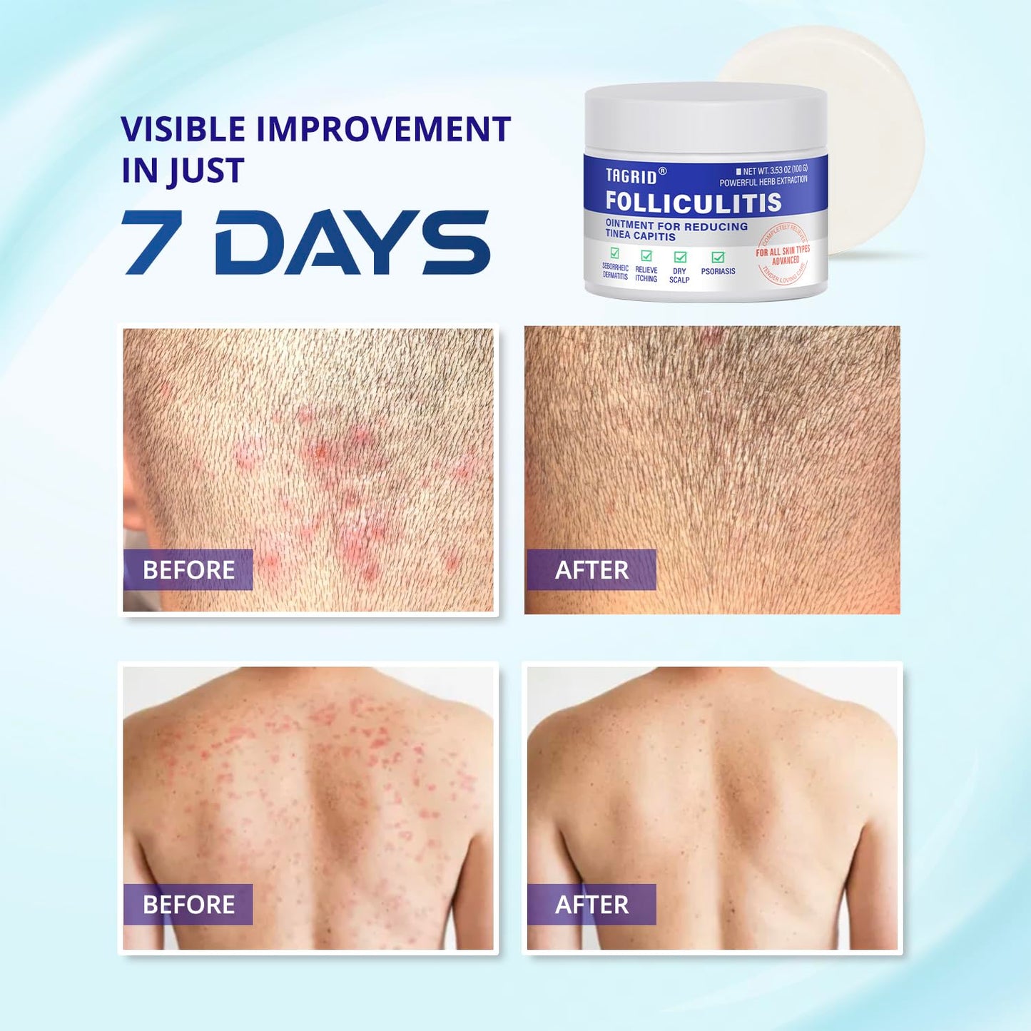 TAGRID Folliculitis Cream, Ingrown Hair, Soothing Scalp, Face & Body Cream - Hydrating & Refreshing - 100g