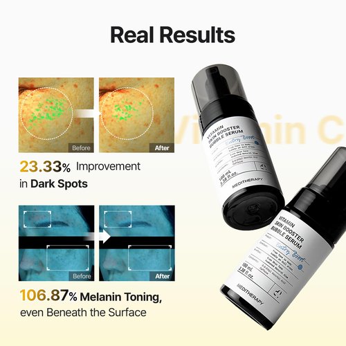 MEDITHERAPY Vitamin C Serum for Face – Micro-Bubble Formula for Instant Absorption, Visibly Radiant Glow – Advanced Vitamin C, Non-Irritating AM/PM Use for Sensitive Skin – 3.38 fl oz