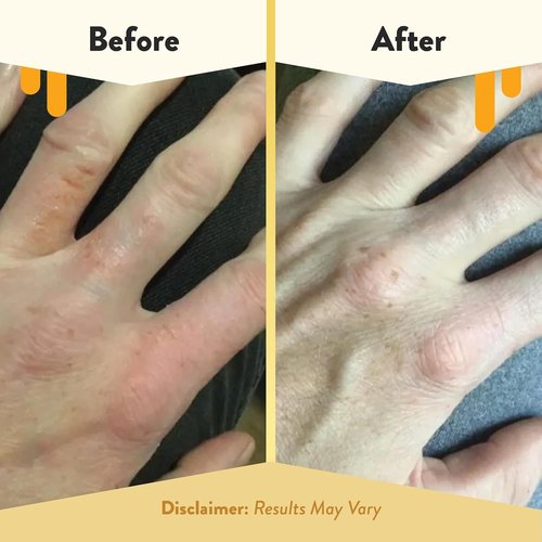 Eczema Honey Oatmeal Hand Cream - Natural Lotion for Eczema Relief | Soothes Dry, Itchy Skin (2 Oz)