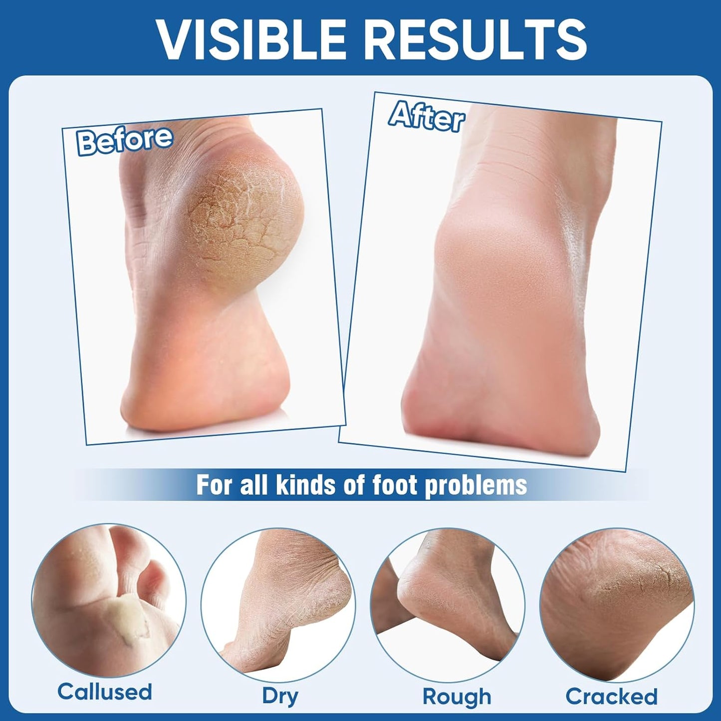 Skiennix Nano Glass Foot File - Professional Callus Remover & Scrubber for Smooth Feet | Includes Heel Socks & Cracked Heel Stick