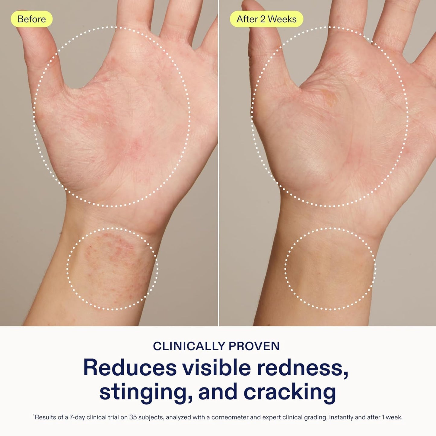 Skinfix Hand Relief Cream - 3 Fl Oz | Reduces Redness, Stinging & Cracking for Sensitive Skin - Fragrance-Free, Vegan