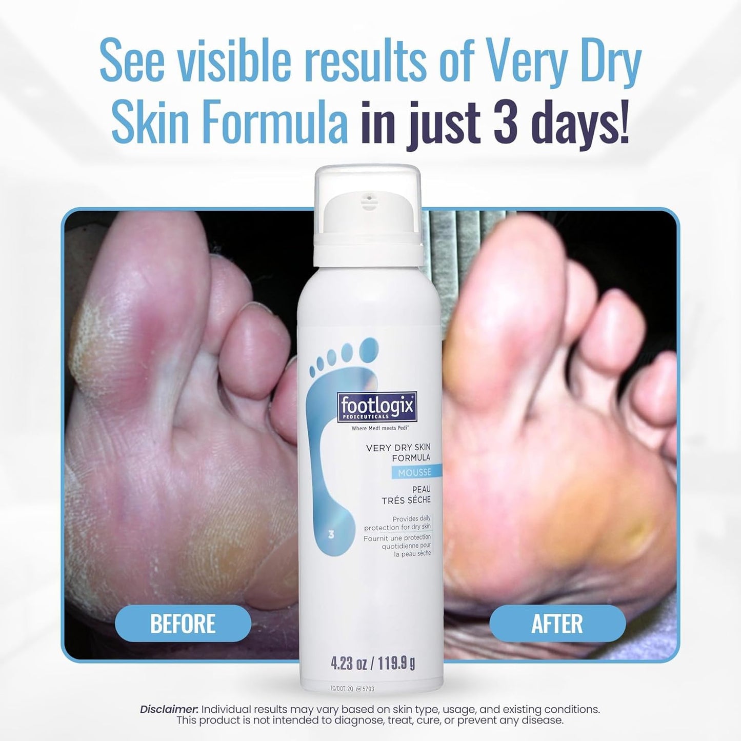 Footlogix Very Dry Skin Formula - Intensive Moisturizer for Dry Feet | 4 oz