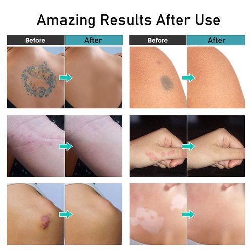 Regine Switzerland Tattoo Cover Up Makeup - Waterproof Concealer for Legs & Body | Long-Lasting Coverage (01)