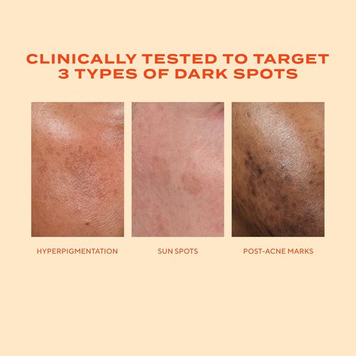 Murad Rapid Dark Spot Correcting Serum - Advanced Anti-Aging Formula with Resorcinol & Glycolic Acids - 1 Fl Oz