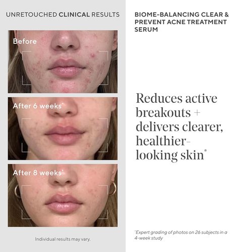 Murad Biome-Balancing Acne Treatment Serum - Salicylic, Mandelic & Glutamic Acid for Clear Skin | 1.0 Fl Oz