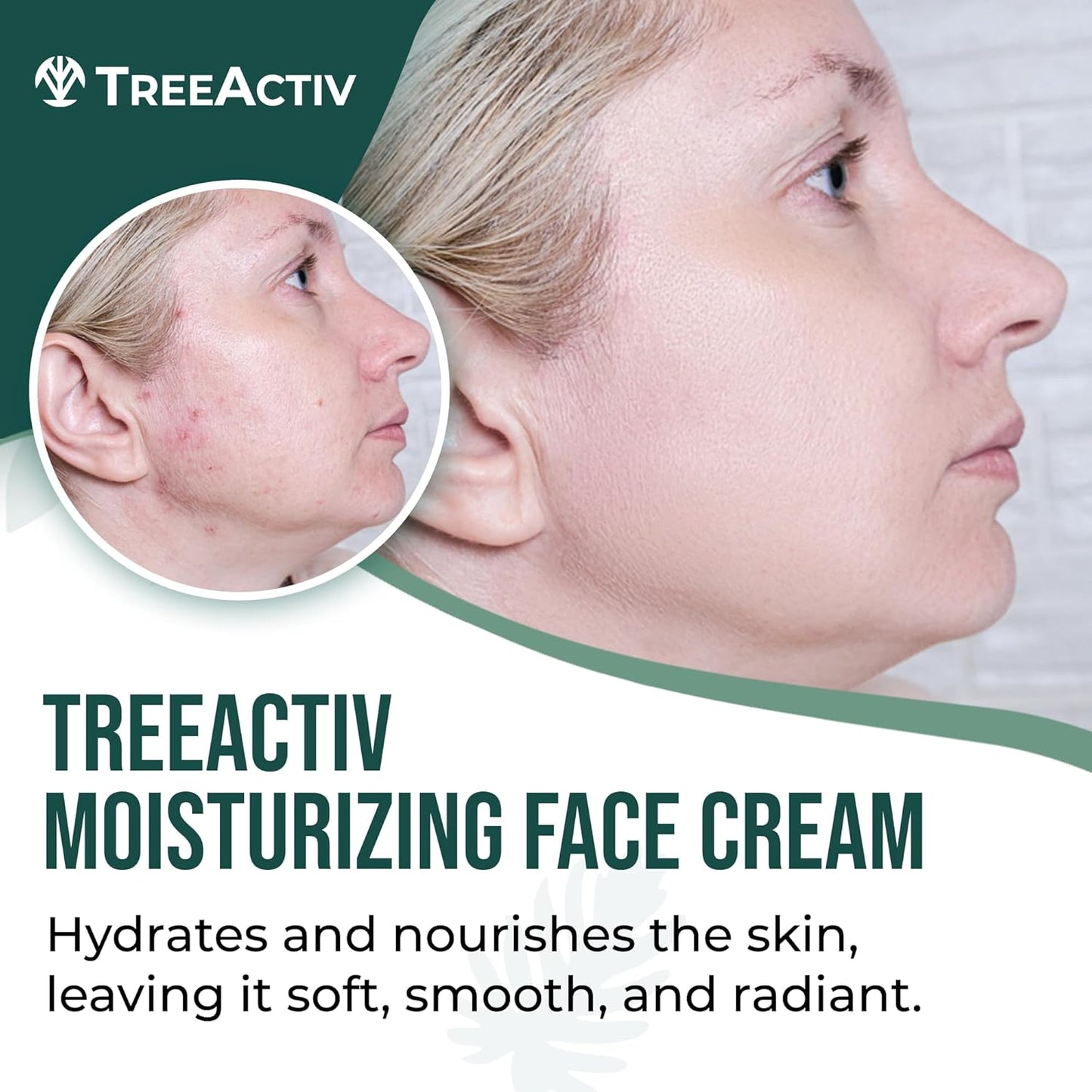 TreeActiv Acne Eliminating Face Cream - Tea Tree Moisturizing Formula for Fresh Skin | 2 fl oz