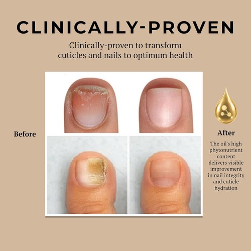 Miracle Fruit Oil Nail Strengthener - 10ml Cuticle Oil for Thin Nails & Growth | Intense Moisture & Protection