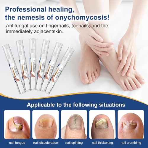 Fungi Nail | Extra Strength Toenail Fungi Treatment Pen - 25% Undecylenic Acid for Damaged Nails
