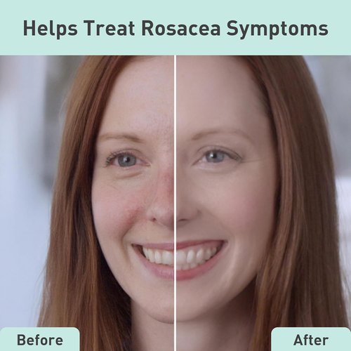 PROcure Rosacare Redness Relief Face Mask - 5 Pack | Hydrating Hyaluronic Acid & Calming Licorice Root for Sensitive Skin