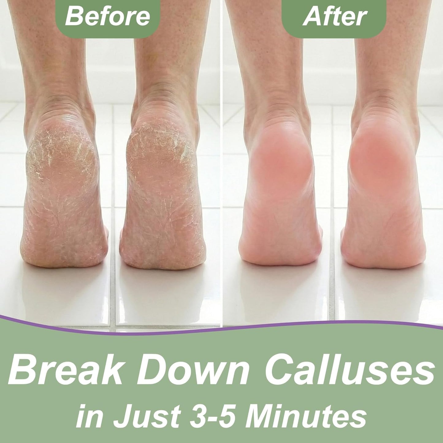 Skiennix Callus Remover Gel - Extra Strength 8 oz Foot Care with Double-Sided File & Spa Kit