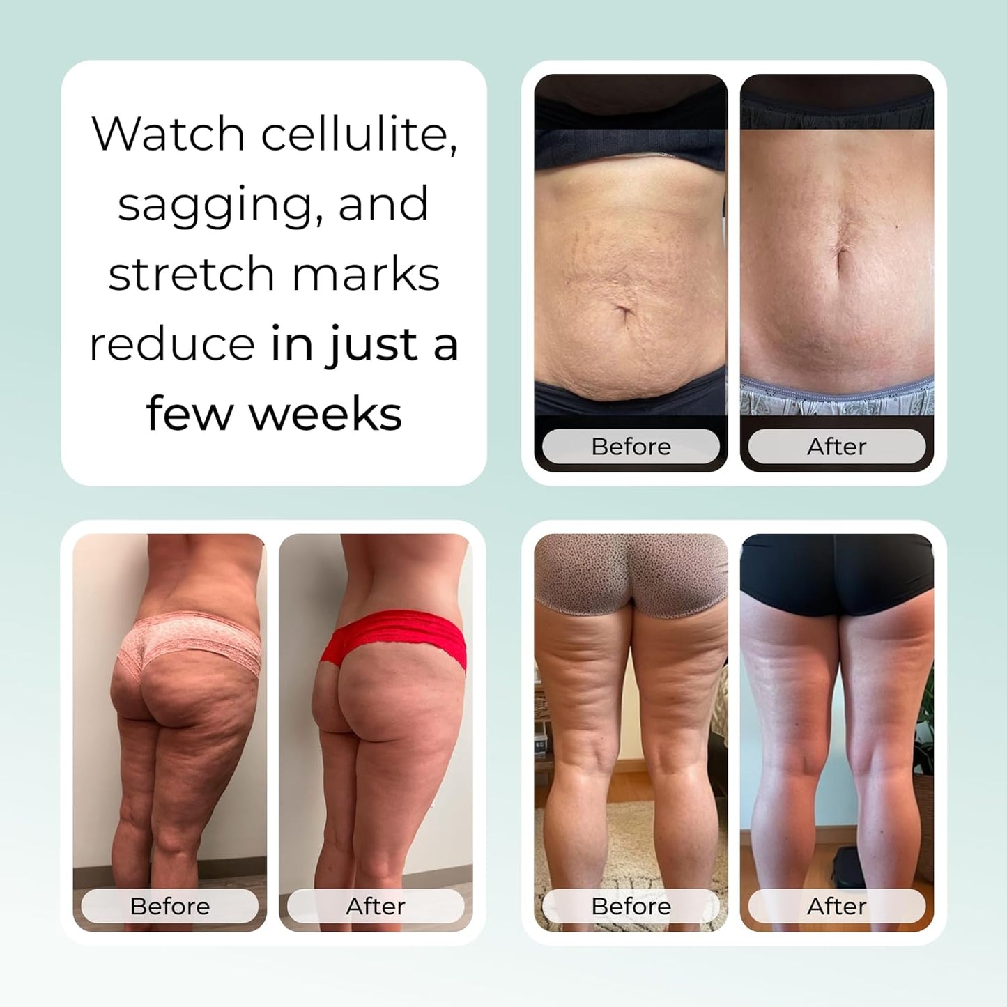 Sculpiflex Stretch Mark Cream - Hydrating & Smoothing Formula for Pregnancy & Weight Changes | 2.82oz