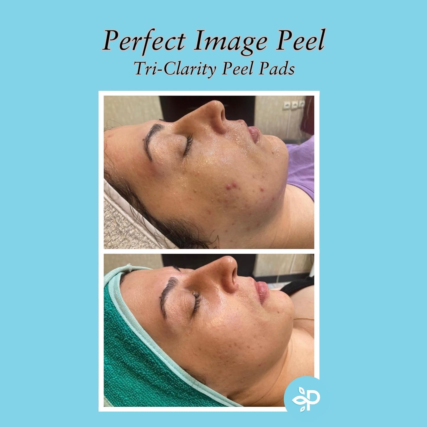 Tri-Clarity | Peel Pads with Salicylic Acid & Tea Tree Oil - 25% Strength for Clear Skin