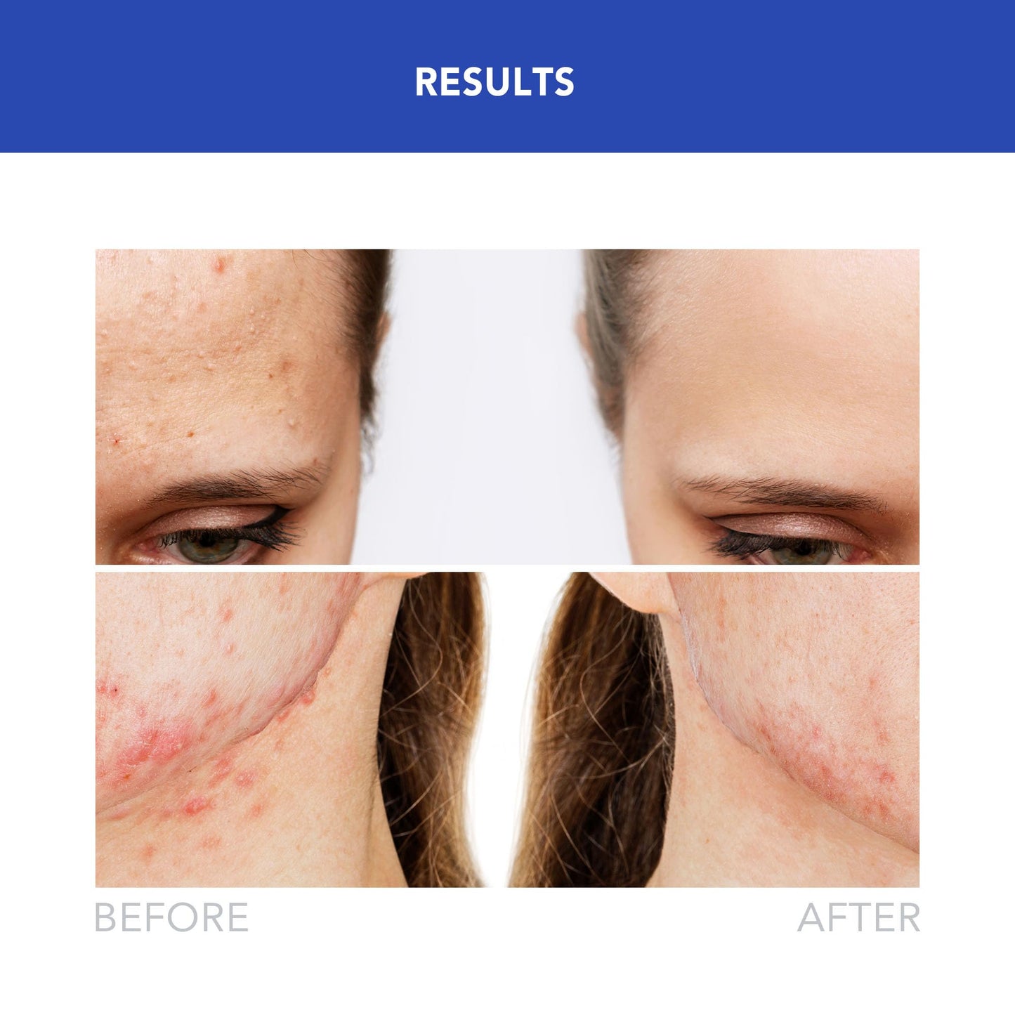 Foreo ESPADA 2 LED Light Device - Blemish Treatment Skincare Device - Medical-grade Silicone - Scar Treatment for Face - Pimple & Blemish Removal - FDA cleared - Cobalt Blue