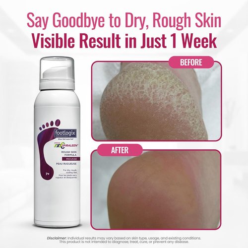 Footlogix Rough Skin Formula - Mousse for Dry, Cracked Heels & Feet Treatment | 4.23oz