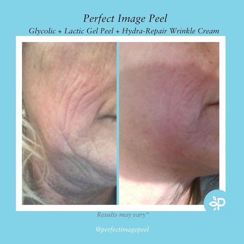 Regine Switzerland Glycolic Gel Peel - 10% Strength with Retinol & Green Tea Extract