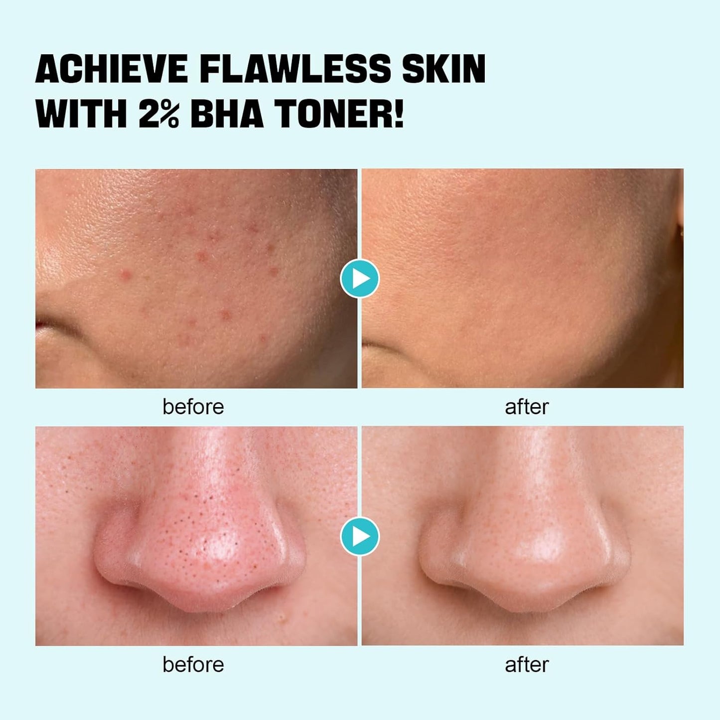 ZealSea Salicylic Acid Toner - BHA Liquid Exfoliant for Blackhead Removal | 6.76 oz, Alcohol-Free, Vegan