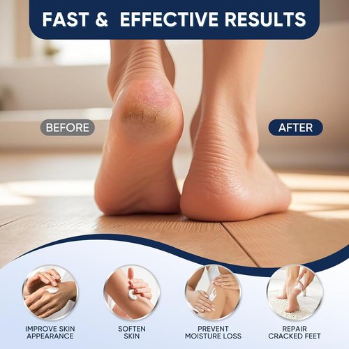 Regine Switzerland Urea Cream 40% - Maximum Strength Foot & Hand Cream for Dry, Cracked Skin