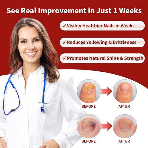 Regine Switzerland Toenail Fungus Treatment - Extra Strength Antifungal Nail Repair with Undecylenic Acid | 30ml