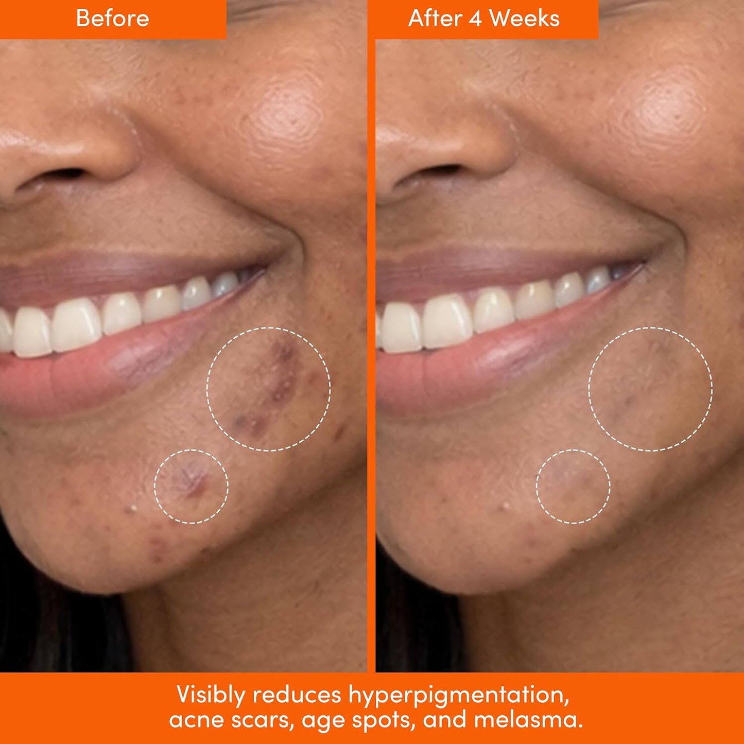 UNSPOTTED Dark Spot Correction Serum - Exfoliating AHA Formula with Azelaic & Glycolic Acids | 1oz