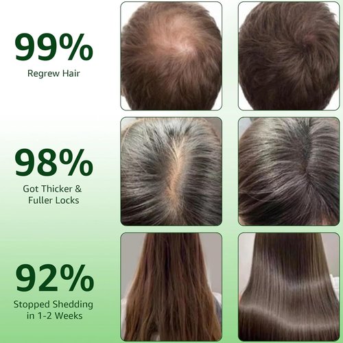 Hair Regrowth System by HairMax - Ginseng & Peppermint Formula | Thicker, Stronger Hair for Men & Women
