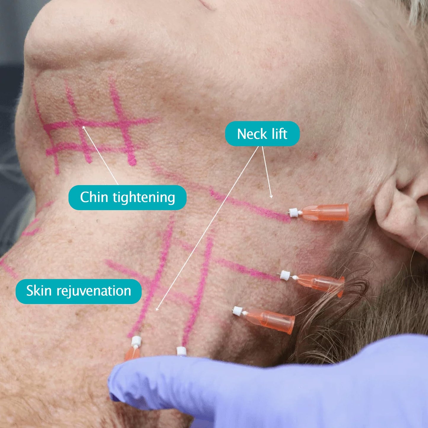 ESTEVO PDO Screw Thread, Improves Skin, Lift and Restore Skin Elasticity and Radiance, Pdo Thread Increase Firmness (20PCS-27G*60mm)