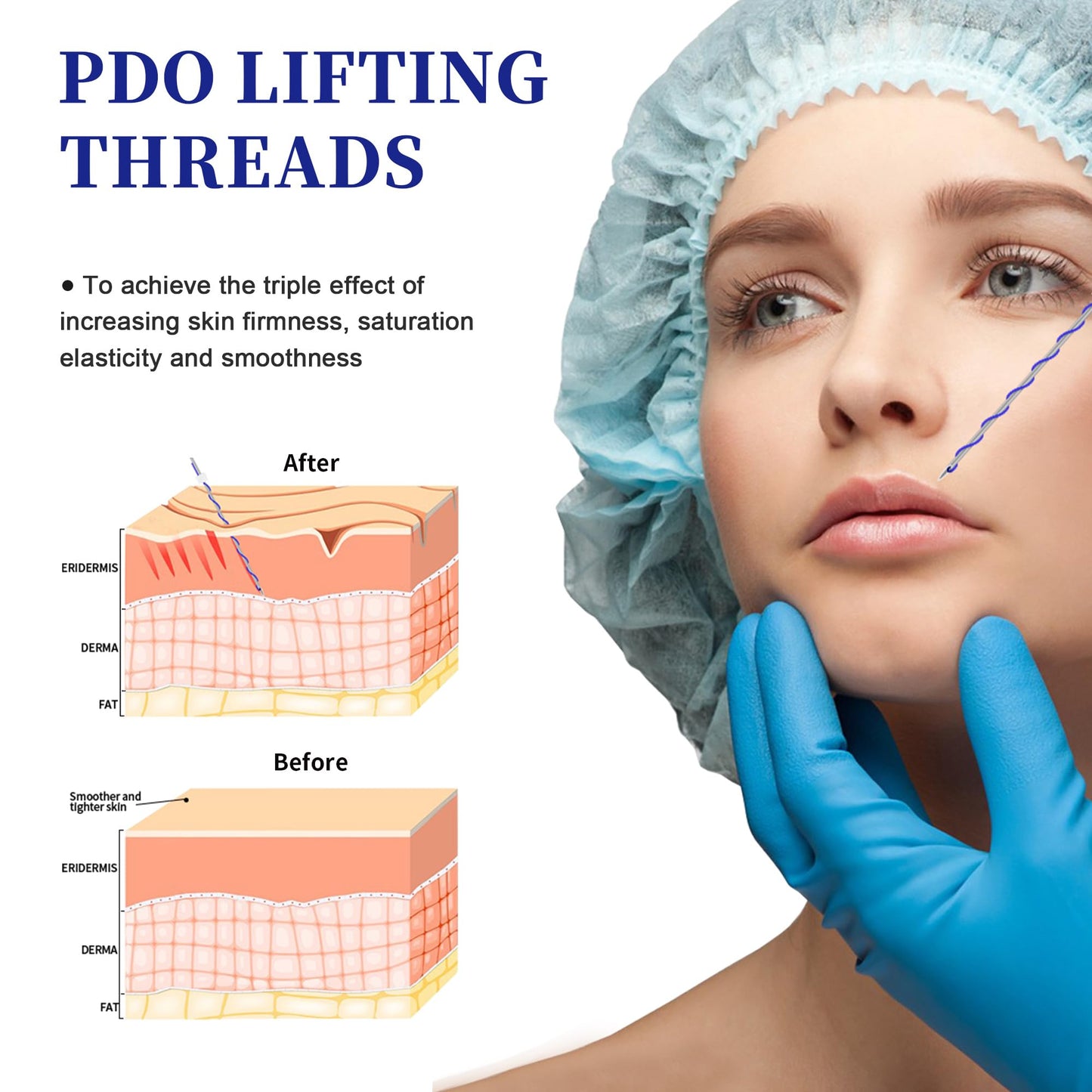 SOZOOM PDO Screw Threads, PDO Thread Lift Korea Whole Body Lifting (100PCS-27G-60mm)