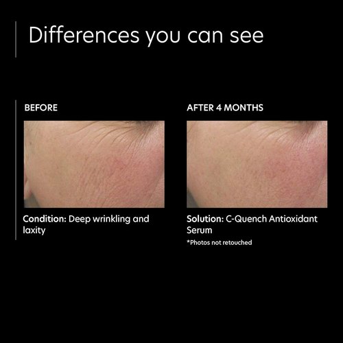 PCA SKIN Vitamin C Quench Face Serum - Hydrating Antioxidant for Oily & Acne-Prone Skin (1 fl oz)