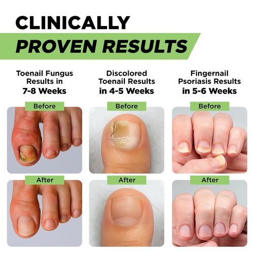 Footcure Antifungal Nail Treatment Pen - Extra Strength Toenail Fungus Repair with 25% Undecylenic Acid & Tea Tree Oil