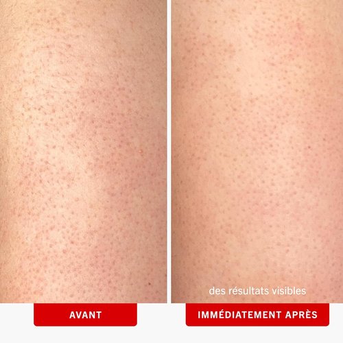 First Aid Beauty KP Bump Eraser Body Scrub - 10% AHA Exfoliator for Keratosis Pilaris | 8 oz, Sensitive Skin Safe