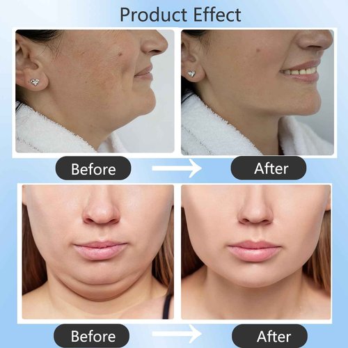 Chinology Double Chin Lifting Mask, Reusable Upgraded Double Chin Reducer, Helps Create A Three-Dimensional Jawline, Sleep Mask for Face and Neck Upgraded Deep Collagen Firming Mask (5 Pcs)