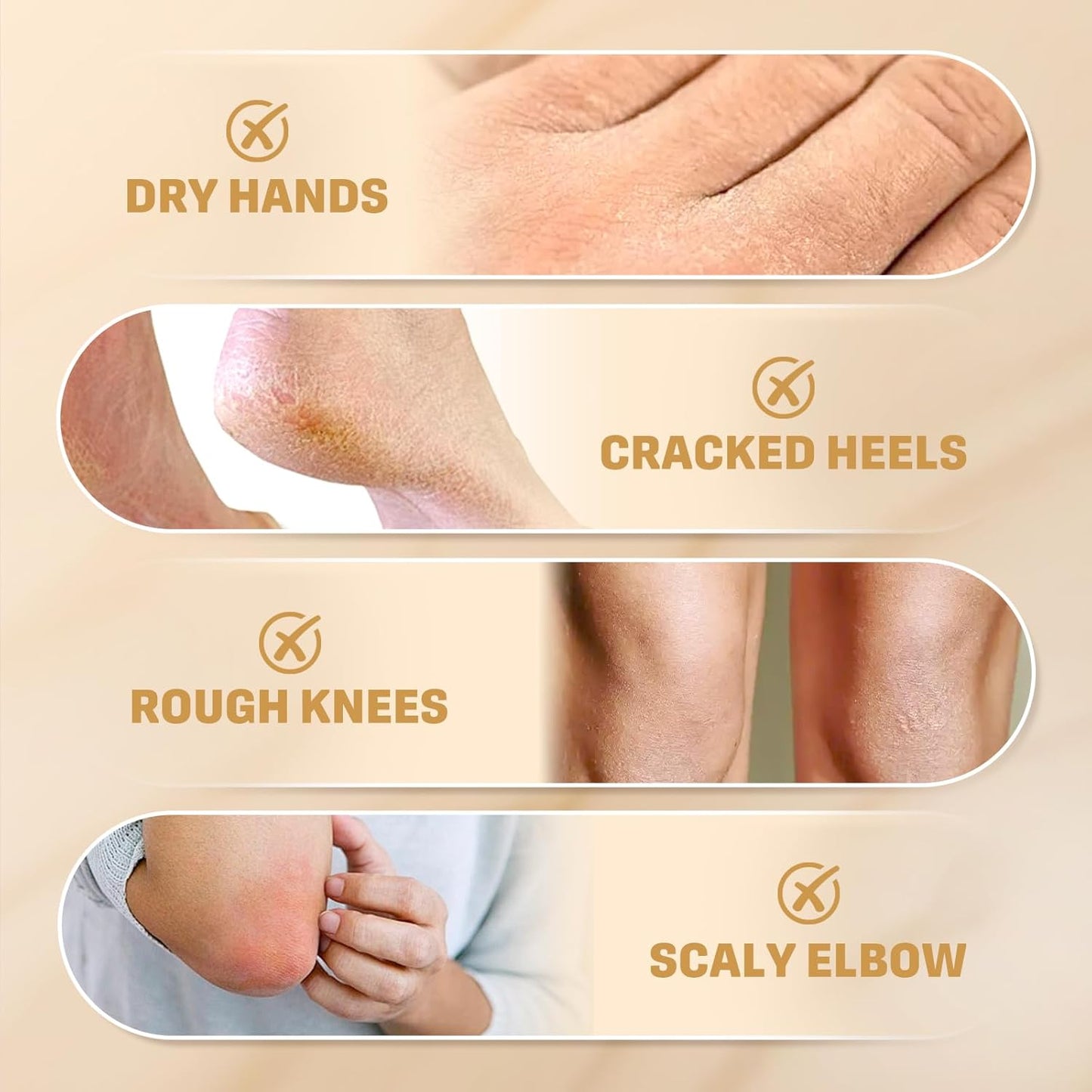 Urea Cream 60% with 2% Salicylic Acid - Maximum Strength Moisturizer for Rough, Dry Skin | 150g