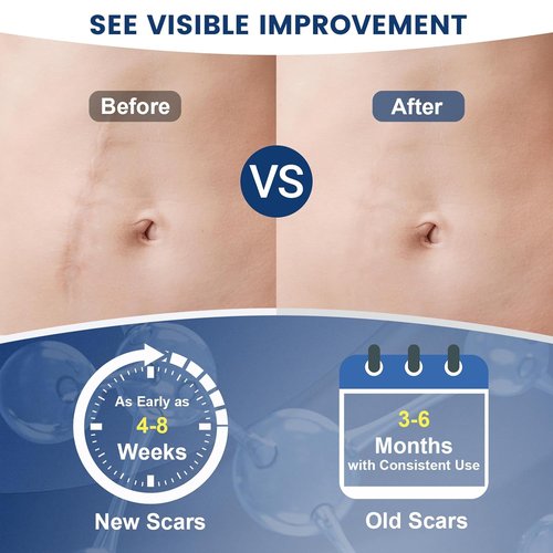100% Silicone Scar Gel Scar Cream, Advanced Silicone Gel for Removal of Surgical, Burns, Acne Scar, Old and Recent Scars and Stretch Marks, 1.7 oz/50ml