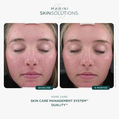 Marini SkinSolutions Duality - 10% Benzoyl Peroxide Acne Treatment & Anti-Aging Retinol Cream - 1 oz