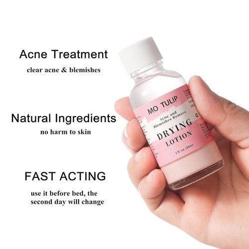 MO TULIP Acne Drying Lotion - Overnight Spot Treatment for Face & Body | 1 oz Pimple & Blemish Solution
