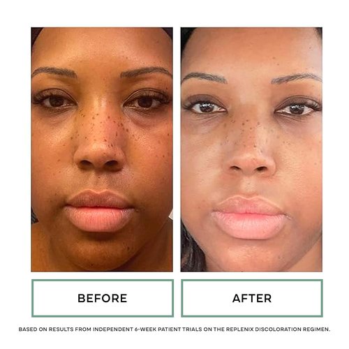 Replenix Vitamin C Pro Collagen Serum - Brightening Anti-Aging Treatment for Skin Discoloration